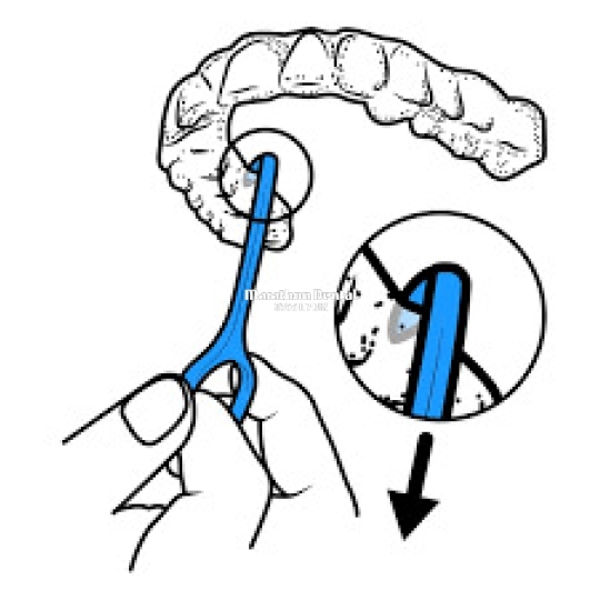 Dụng cụ tháo máng niềng răng trong suốt